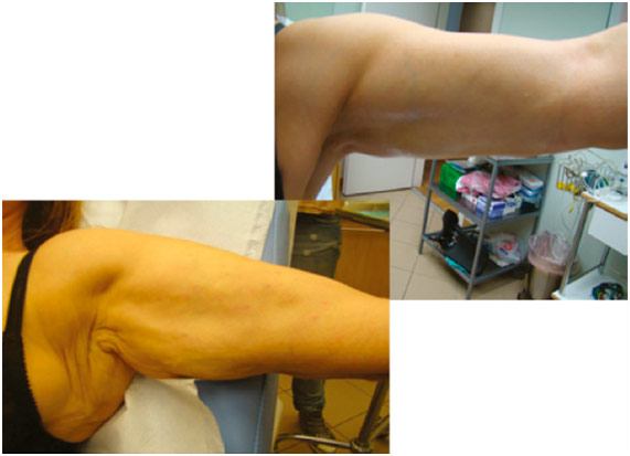 Tratamiento-en-el-brazo-con-hilos-tensores-corporales