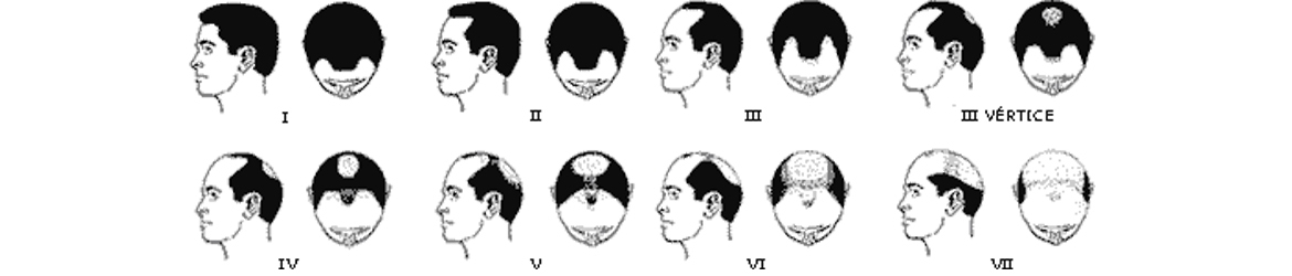 tipos-alopecia-androgenetica-zaragoza
