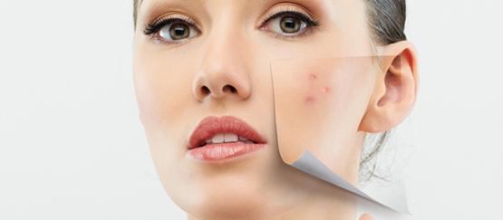 tratamiento-peeling-facial